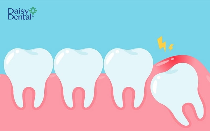 Đau răng do mọc răng khôn có thể sử dụng thuốc giảm đau răng