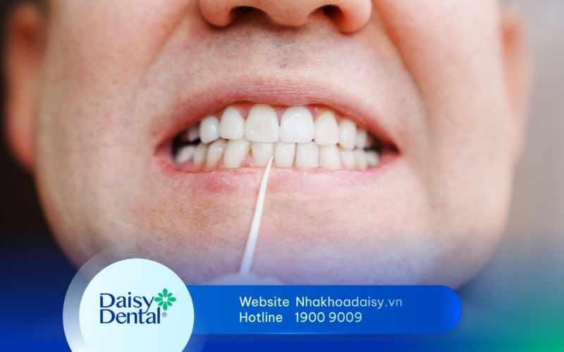 Có nên xỉa răng sau khi ăn không