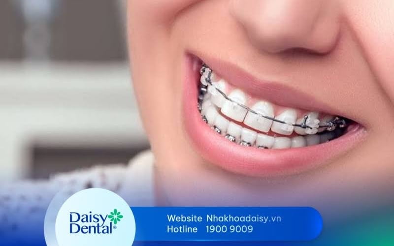 niềng răng khớp cắn ngược bao lâu