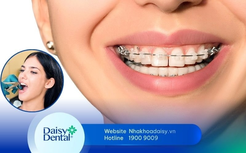 niềng răng nhổ răng số 5