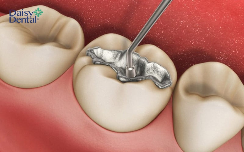 Trám răng bằng vật liệu Amalgam là kỹ thuật phổ biến trong nha khoa