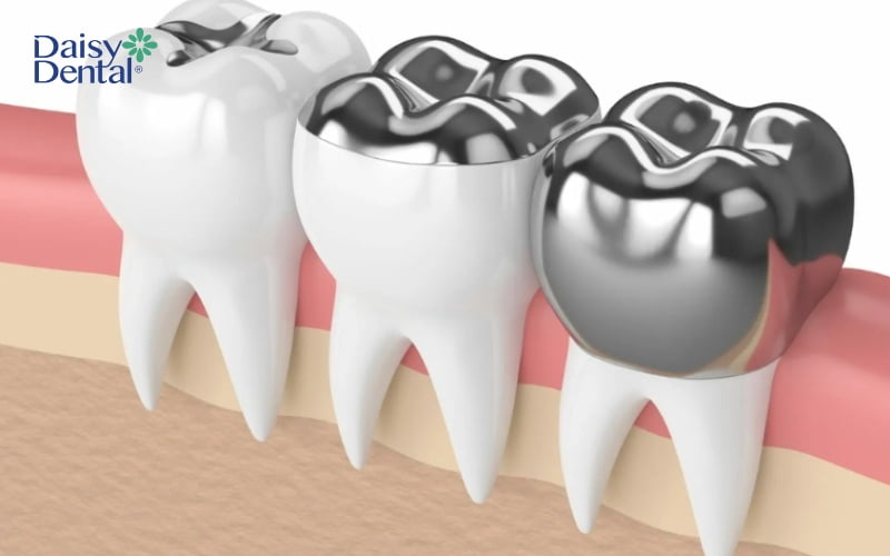 Trám răng Amalgam được áp dụng khá phổ biến nhờ có nhiều ưu điểm