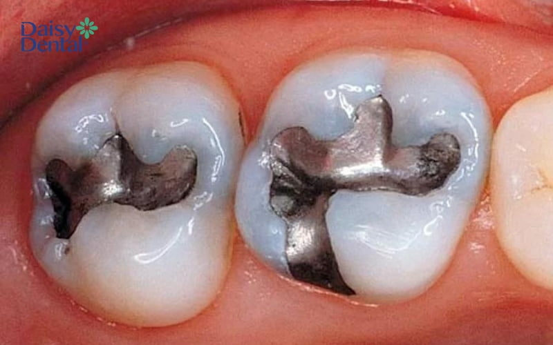 Phương pháp này có tính thẩm mỹ thấp nên thường được khuyến cáo sử dụng cho răng hàm