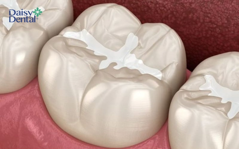 Một trong những phương pháp thay thế là trám răng bằng vật liệu composite