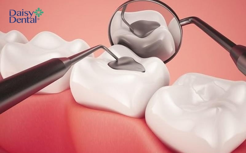 Tùy vào tình trạng răng mà chi phí trám răng sẽ khác nhau