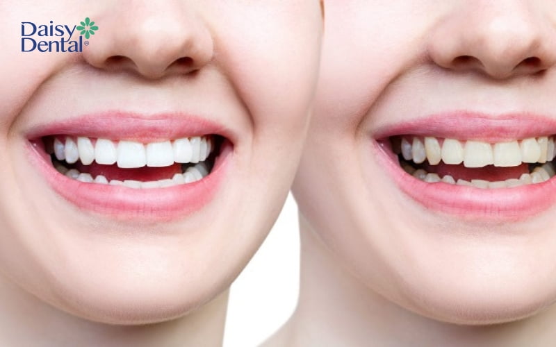 Trám răng được bác sĩ khuyến khích áp dụng cho những trường hợp răng bị mẻ do nhiều nguyên nhân