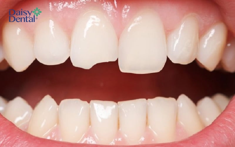 Chi phí trám răng có sự chênh lệch giữa các nha khoa, tùy thuộc vào tình trạng răng của mỗi người