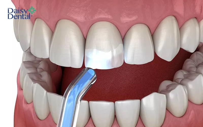 Trám răng mẻ thường không gây đau nhức hay khó chịu