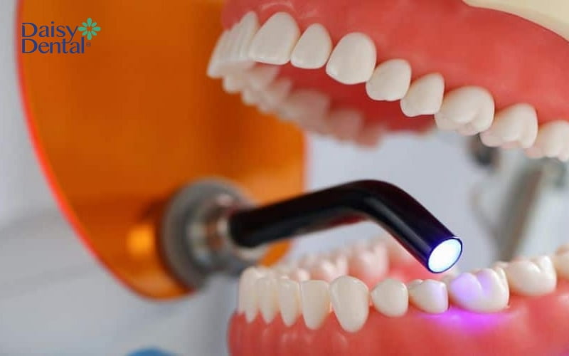 Thời gian trám răng trung bình khoảng 15-30 phút tùy vào mức độ răng mẻ
