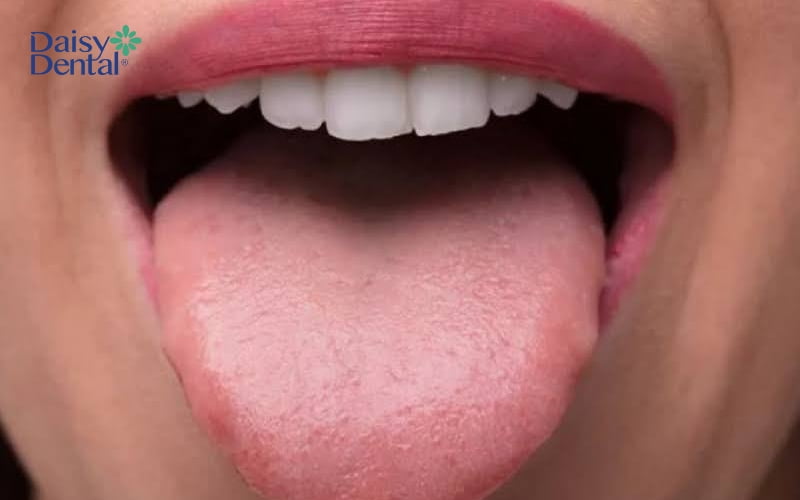 Lưỡi được vệ sinh sạch sẽ, không cặn bẩn sẽ giúp ngăn ngừa tình trạng vi khuẩn tích tụ và gây bệnh