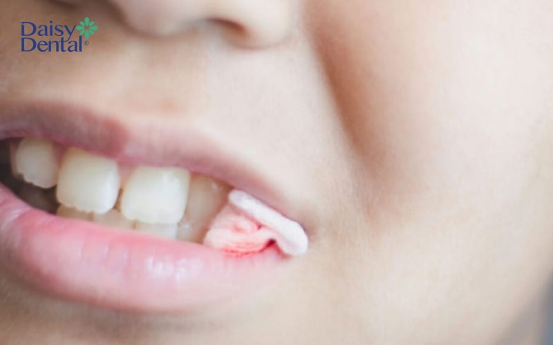 Bệnh nhân cần cắn chặt bông gòn ít nhất khoảng 30 phút sau khi phẫu thuật để cầm máu