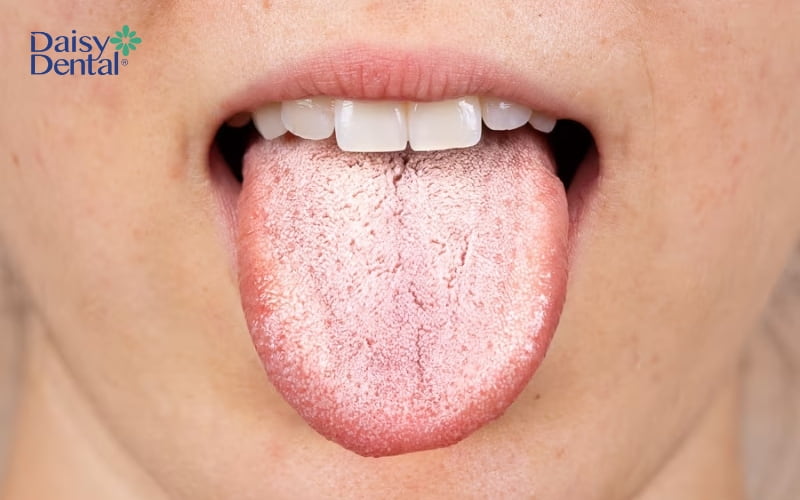 Lưỡi không được làm sạch thường xuyên là điều kiện để vi khuẩn tích tụ, sinh sôi