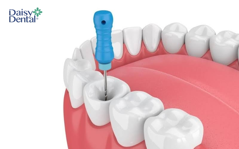 Trong trường hợp tủy răng bị viêm, bác sĩ sẽ tiến hành điều trị nội nha