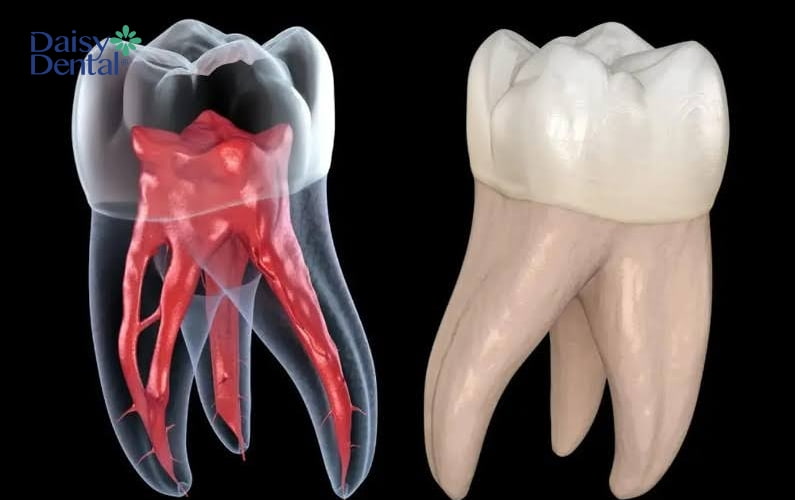 Tùy vào số lượng chân răng và cấu tạo của ống tủy mà quá trình điều trị tủy có thể chia thành nhiều lần