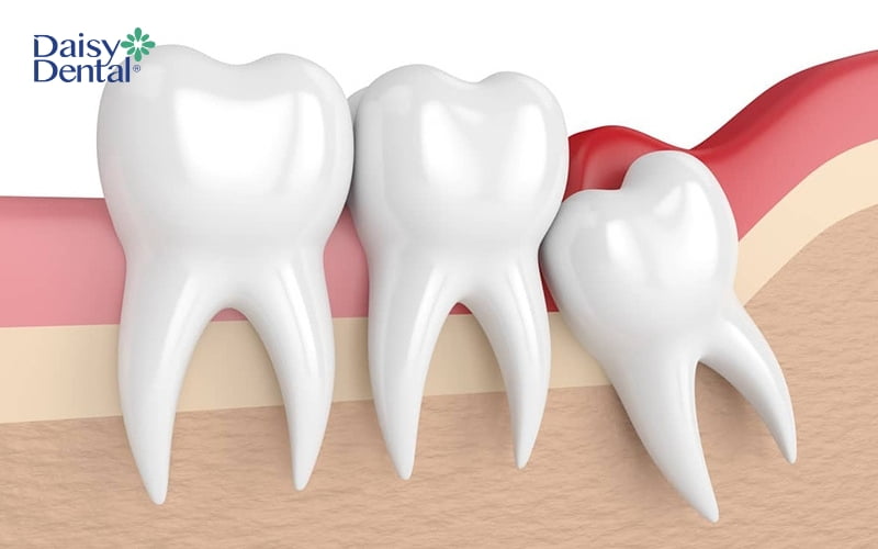 Trong quá trình răng khôn mọc lên, bạn có thể cảm thấy đau nhức, khó chịu