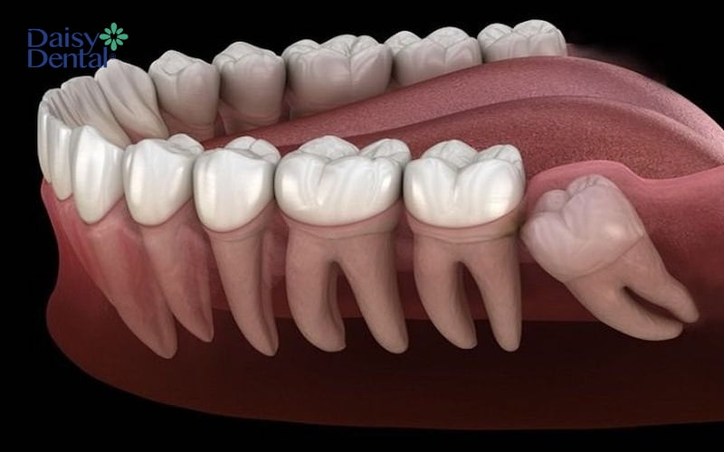 Bạn nên tuân thủ chỉ định nhổ răng nếu gặp tình trạng răng khôn mọc lệch