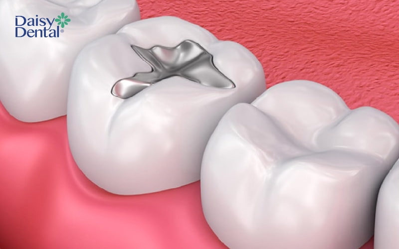 Vật liệu trám răng cần thời gian để đông cứng trên răng