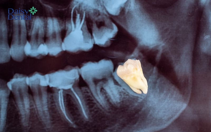 Khi răng khôn mọc ngầm, mọc lệch có thể ảnh hưởng đến dây thần kinh