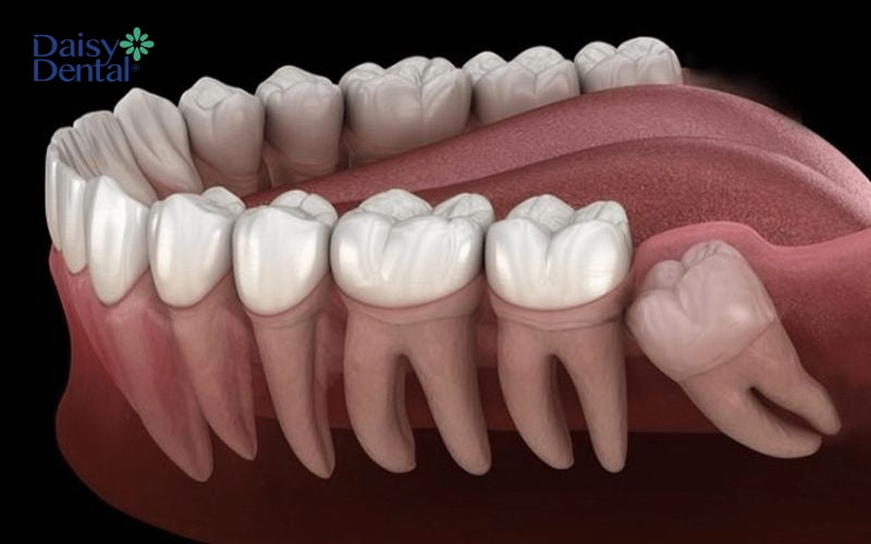 Quá trình mọc răng khôn thường chia theo từng khoảng thời gian ngắn