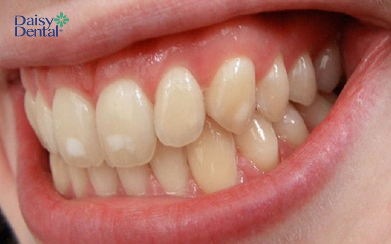 Nếu không được vệ sinh kỹ trong quá trình niềng răng, bạn rất có thể bị đốm trắng trên răng