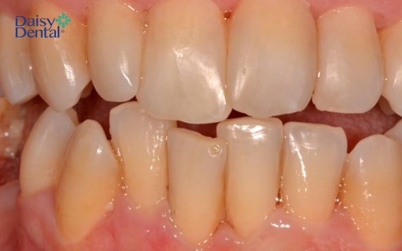 Răng có đốm trắng do nhiễm kháng sinh
