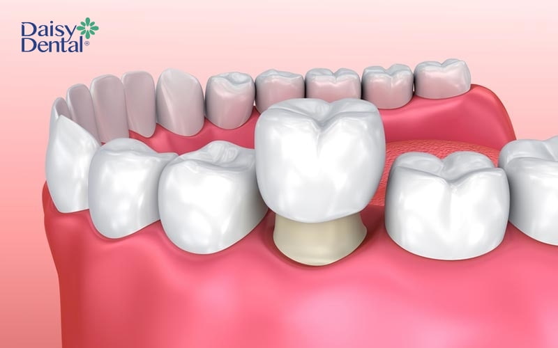 Bọc sứ có khả năng khắc phục đốm trắng trên răng, giúp răng đều màu