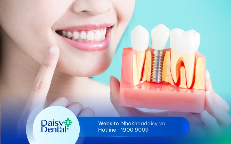 chăm sóc răng sau khi trồng implant
