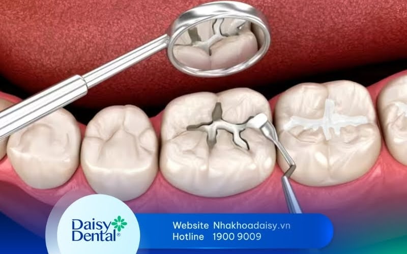 Mới trám răng có được đánh răng không