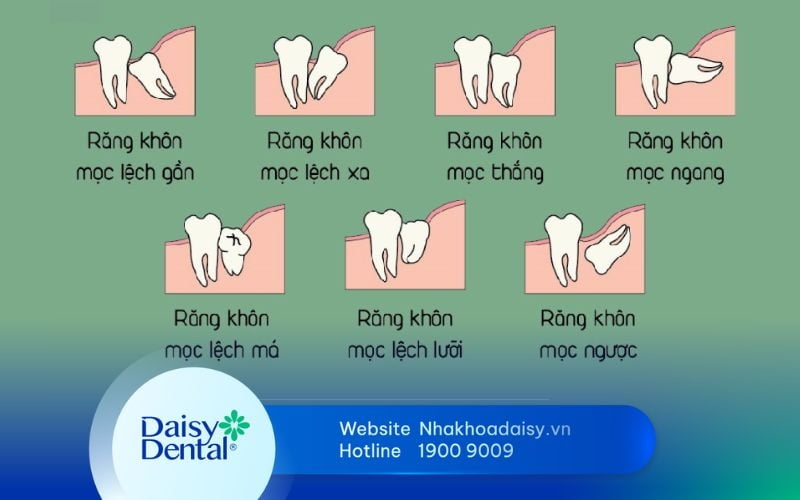 Quá trình mọc răng khôn