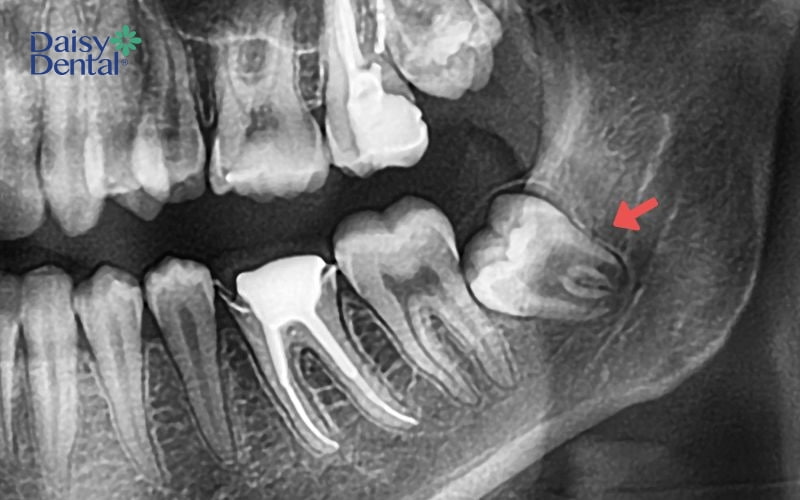 Răng khôn đâm vào răng số 7 là trường hợp cần phải nhổ bỏ nhanh chóng