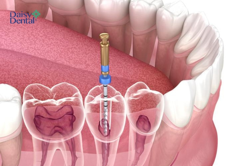 Điều trị tủy răng không đúng kỹ thuật có thể ảnh hưởng nghiêm trọng đến sức khỏe răng miệng