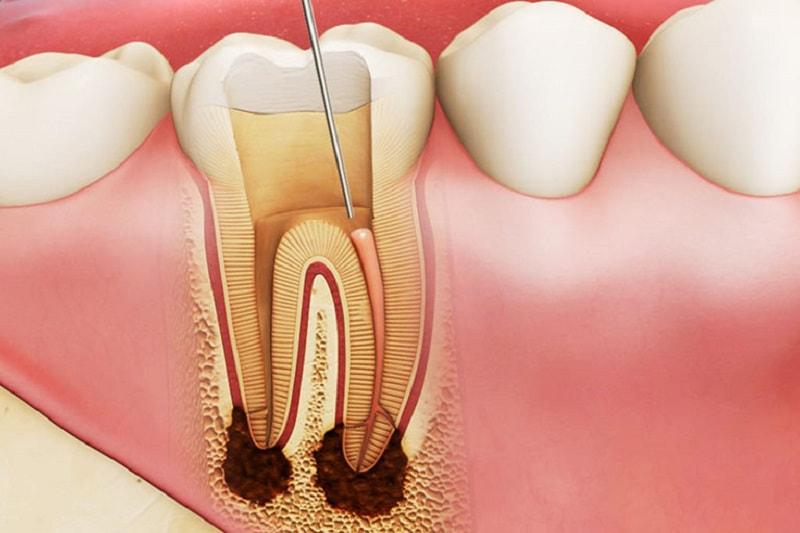Lấy tủy răng không sạch có thể dẫn đến viêm chóp răng.