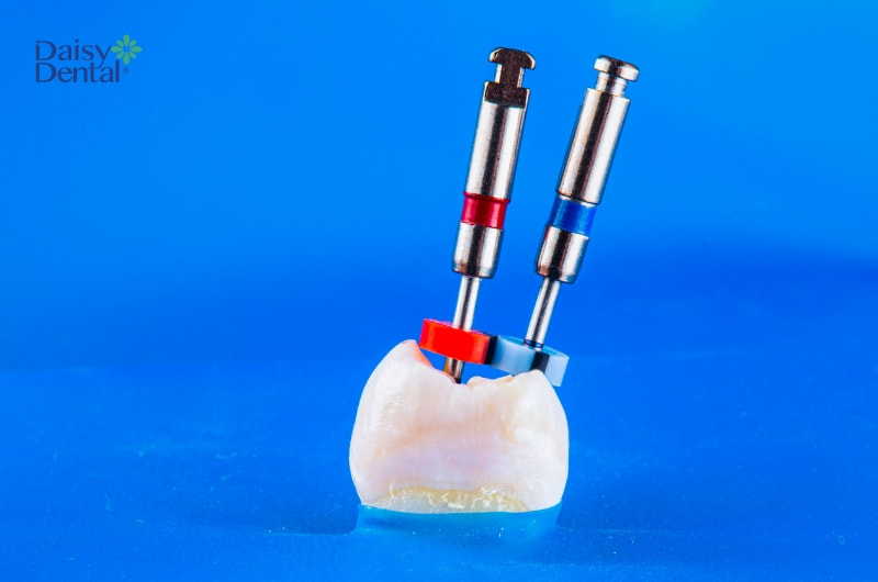 Cách khắc phục lấy tủy răng không sạch là điều trị nội nha thêm một lần nữa