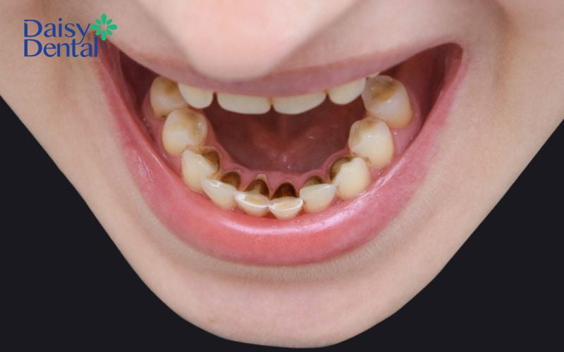 Mảng bám đen trên răng làm mất thẩm mỹ và gây ra nhiều bệnh lý răng miệng
