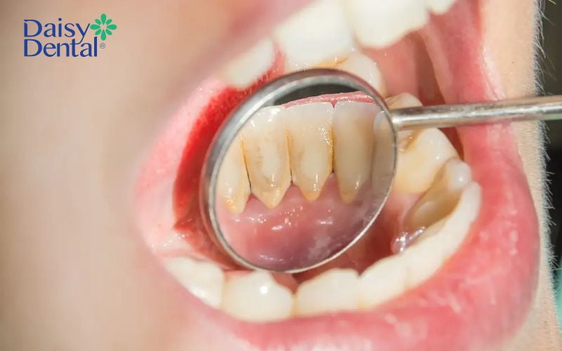 Cao răng tích tụ lâu ngày không được loại bỏ dẫn đến hình thành các đốm đen trên bề mặt răng