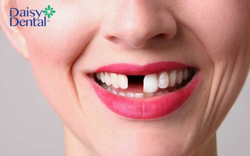 Mất răng gây ảnh hưởng đến tính thẩm mỹ