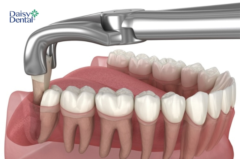 Nhổ răng khôn không đúng cách làm tổn thương mô mềm sẽ gây ra đau nhức dữ dội.