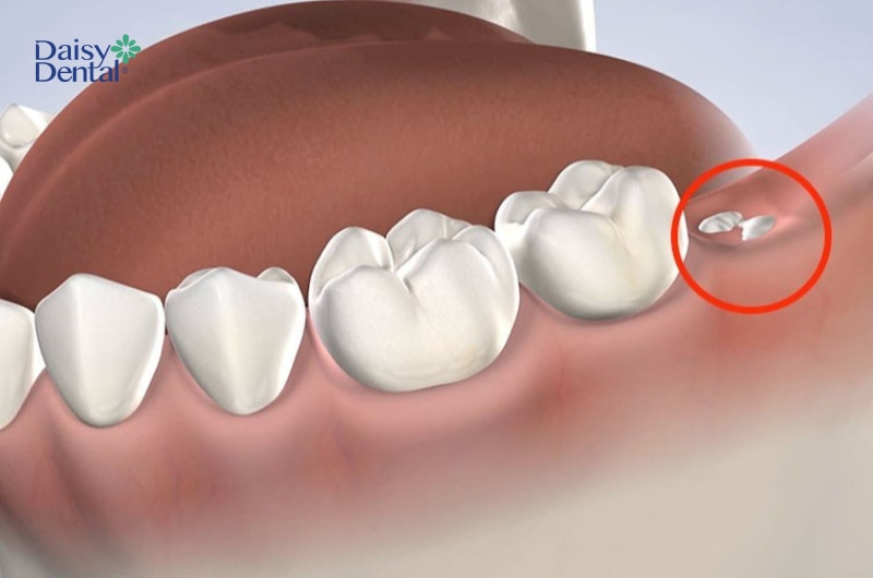 Hình ảnh minh họa nhổ răng khôn còn sót chân răng