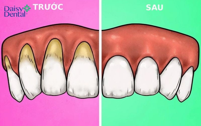 Tình trạng nướu trước và sau khi phẫu thuật ghép lợi