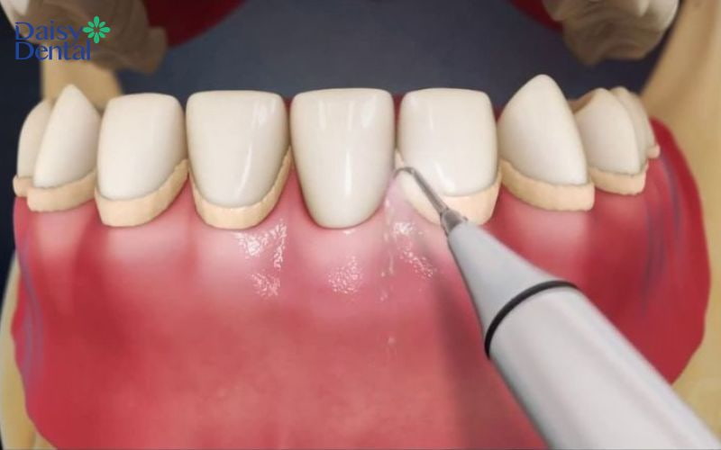 Mô phỏng phương pháp ghép mô liên kết