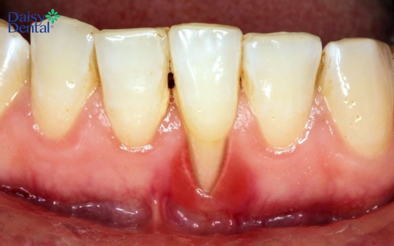 Tình trạng vùng nướu bị viêm