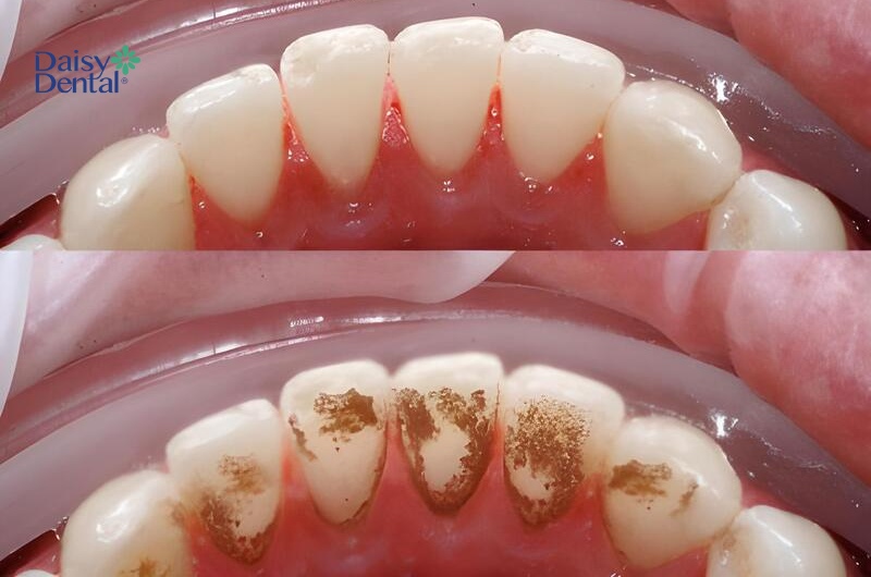 Cạo vôi răng là phương pháp khắc phục tình trạng răng bị đen ở mức độ nhẹ.