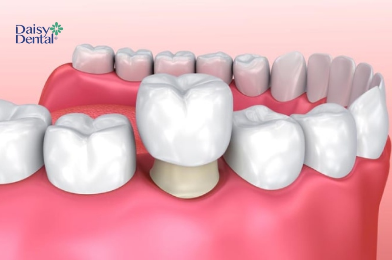 Nếu răng bị tổn thương nghiêm trọng, nha sĩ sẽ chỉ định bọc răng sứ.