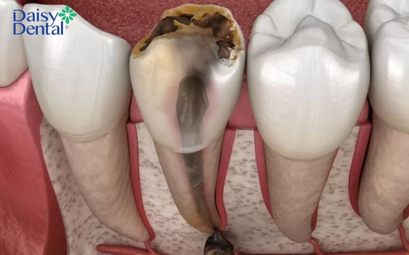 Viêm tủy mãn tính xuất hiện là do quá trình tủy răng bị viêm nhẹ không được điều trị