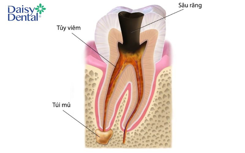 Viêm tủy cấp tính có thể xuất hiện nhiều túi mủ