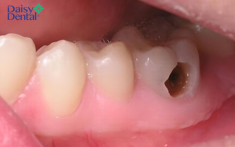Sâu răng là nguyên nhân chủ yếu gây ra tình trạng răng bị chết tủy