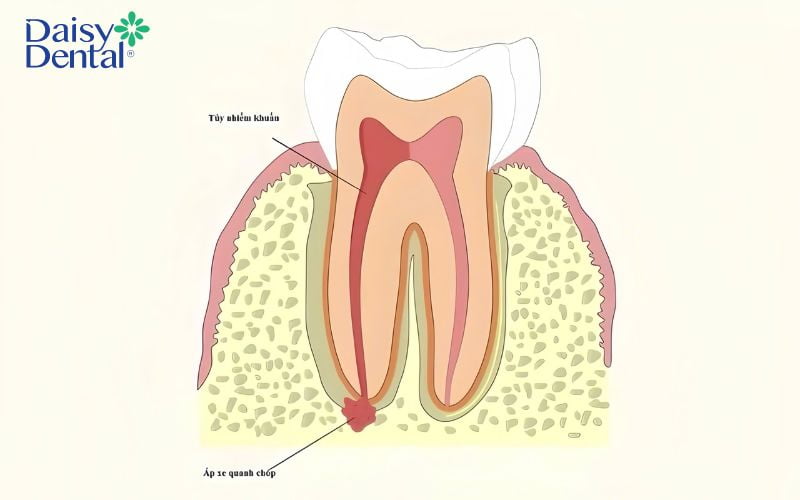 Viêm nướu không được điều trị có thể làm tủy bị tổn thương