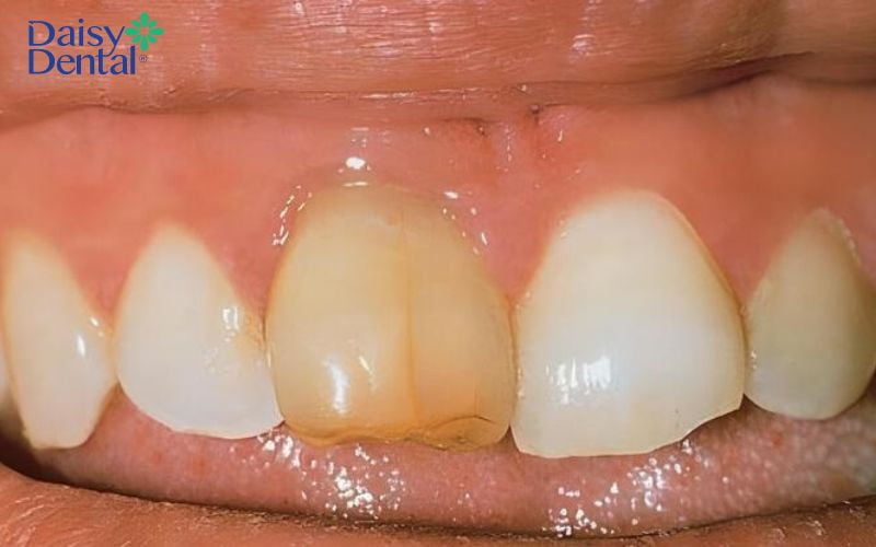 Răng đã bị chết tủy có thể tồn tại khoảng tầm một năm