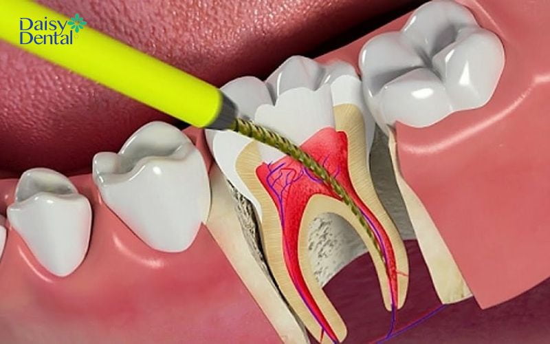 Răng bị lung lay do quá trình hàn trám chưa hoàn thiện