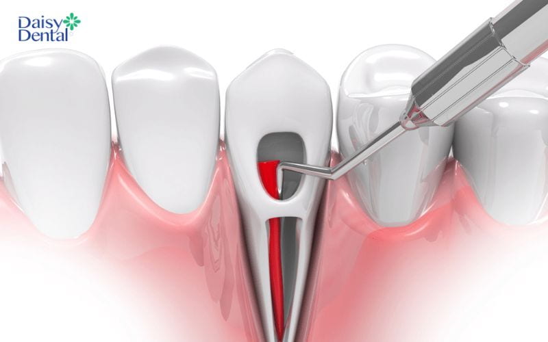 Nha khoa lấy tủy kém chất lượng